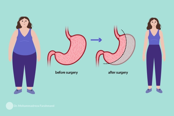 Sleeve Gastrectomy by dr.farahmand